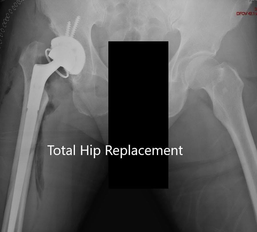 Radiografía postoperatoria que muestra vista AP de la pelvis