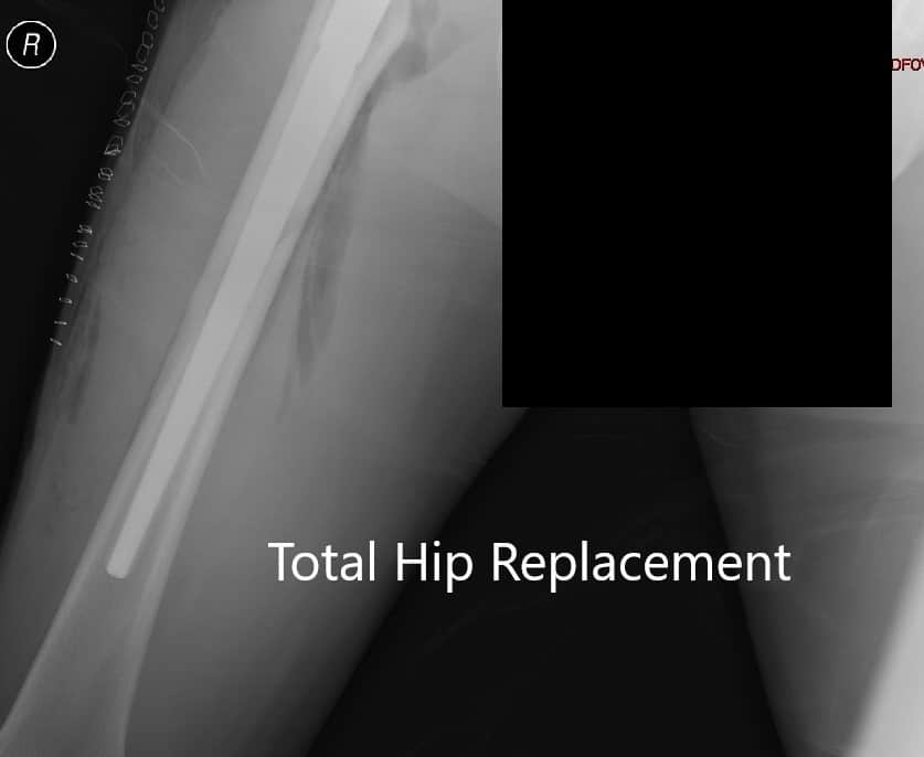 Radiografía postoperatoria que muestra la vista AP de la pelvis - IMG 2