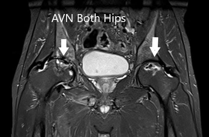 MRI showing bilateral femoral head AVN in T2WI MRI showing bilateral femoral head AVN in T2WI