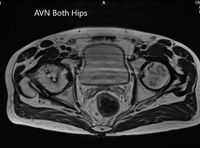 Axial section T2WI showing bilateral AVN of the femoral heads Axial section T2WI showing bilateral AVN of the femoral heads