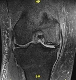Imagen ponderada en T2 que muestra la sección coronal de la rodilla con la señal alterada de la médula ósea y la señal del borde Imagen ponderada en T2 que muestra la sección coronal de la rodilla con la señal alterada de la médula ósea y la señal del borde