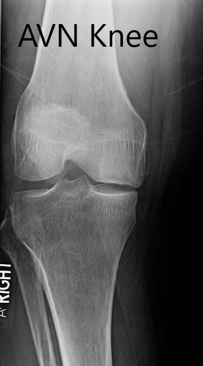Radiografía preoperatoria de la rodilla derecha en vistas anteroposterior y lateral Radiografía preoperatoria de la rodilla derecha en vistas anteroposterior y lateral
