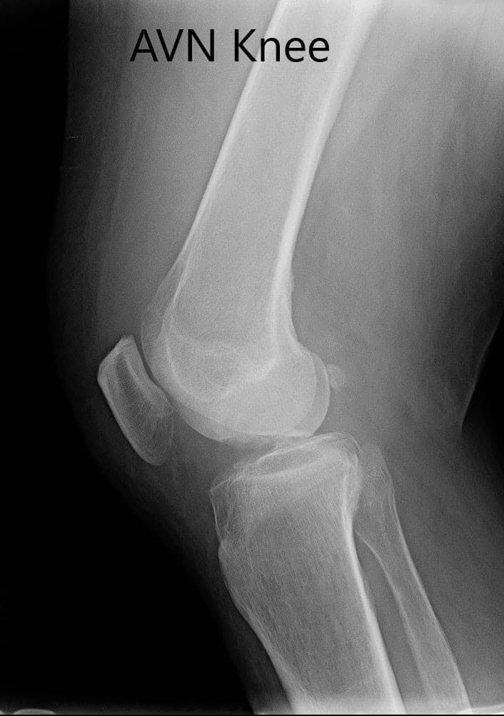Radiografía preoperatoria de la rodilla derecha en vistas anteroposterior y lateral - img 2 Radiografía preoperatoria de la rodilla derecha en vistas anteroposterior y lateral - img 2