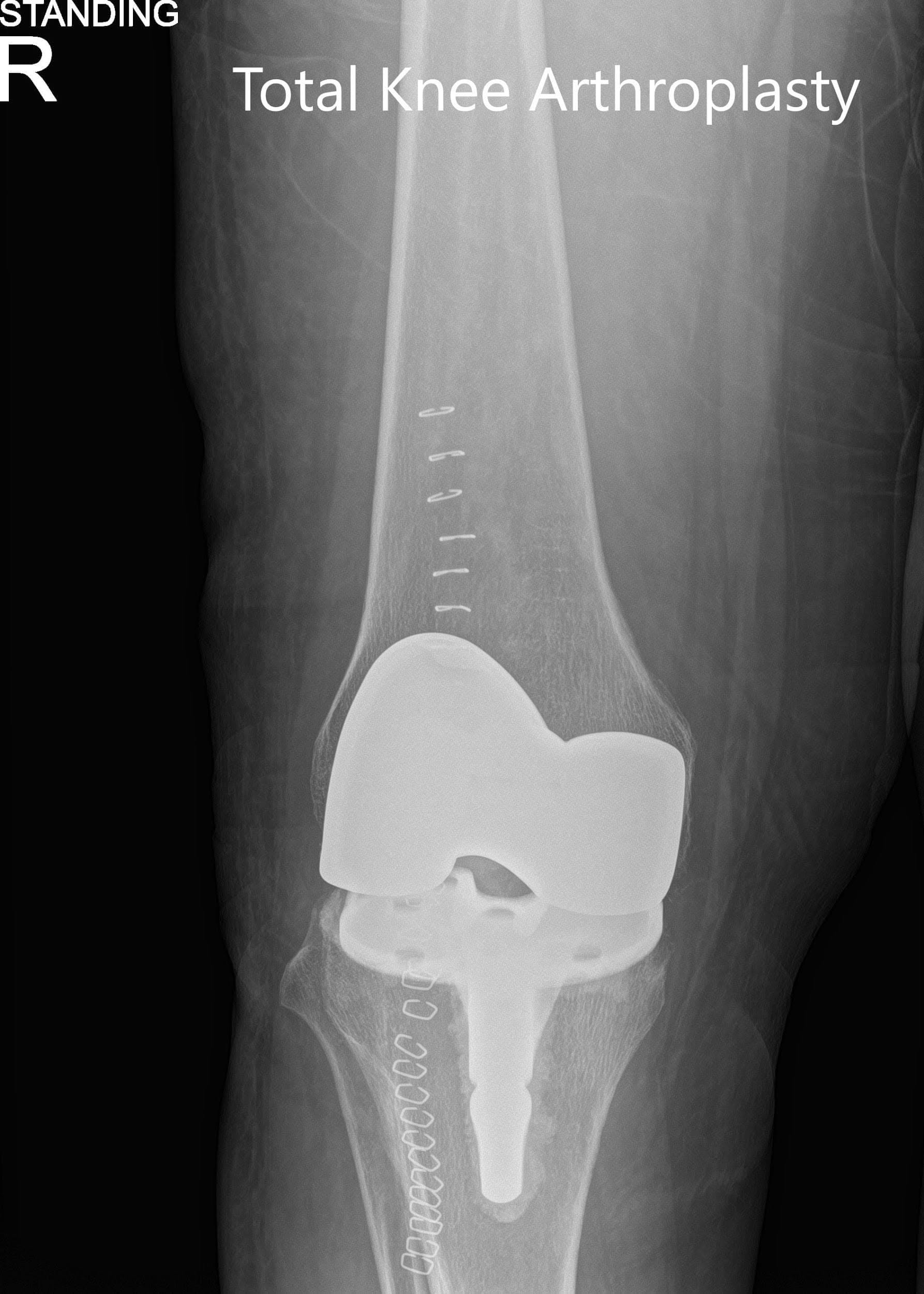 Radiografía postoperatoria que muestra las vistas anteroposterior y lateral de la rodilla derecha. Radiografía postoperatoria que muestra las vistas anteroposterior y lateral de la rodilla derecha