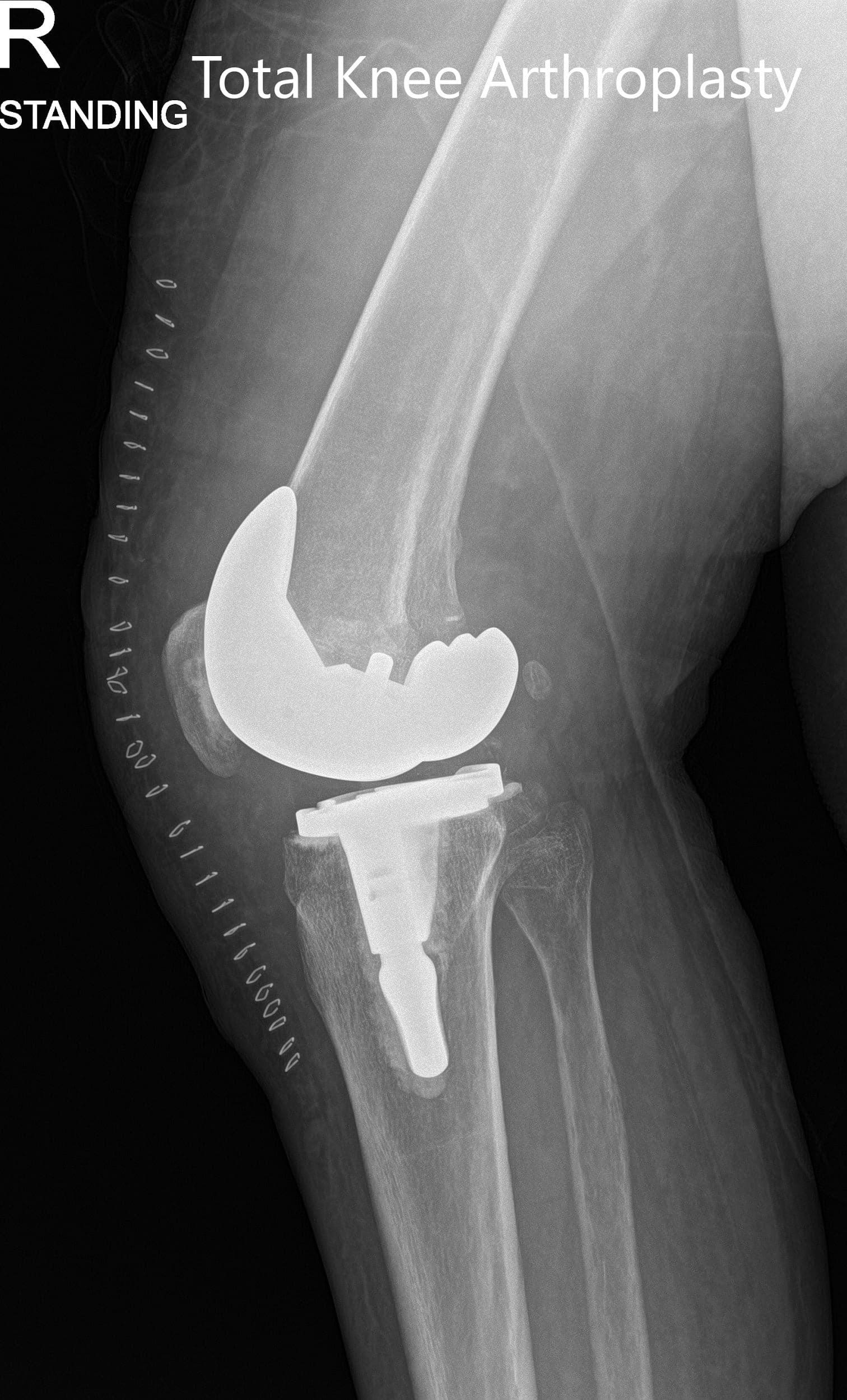 Radiografía postoperatoria que muestra las vistas anteroposterior y lateral de la rodilla derecha - img 2 Radiografía postoperatoria que muestra las vistas anteroposterior y lateral de la rodilla derecha - img 2