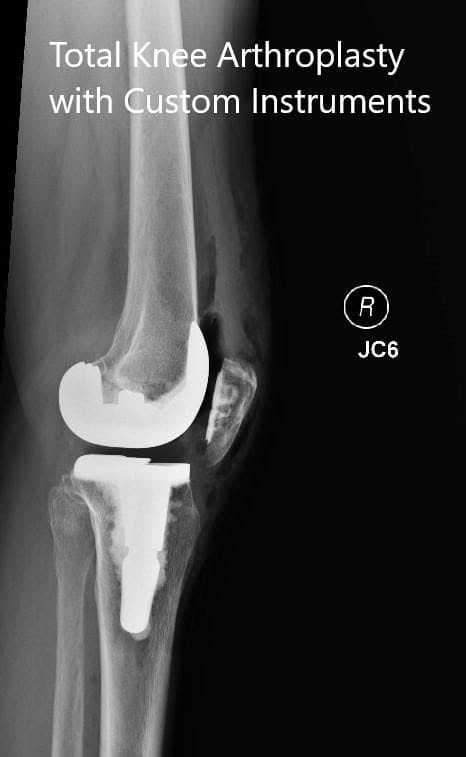 Radiografías postoperatorias que muestran las vistas anteroposterior y lateral de la rodilla derecha - IMG 2