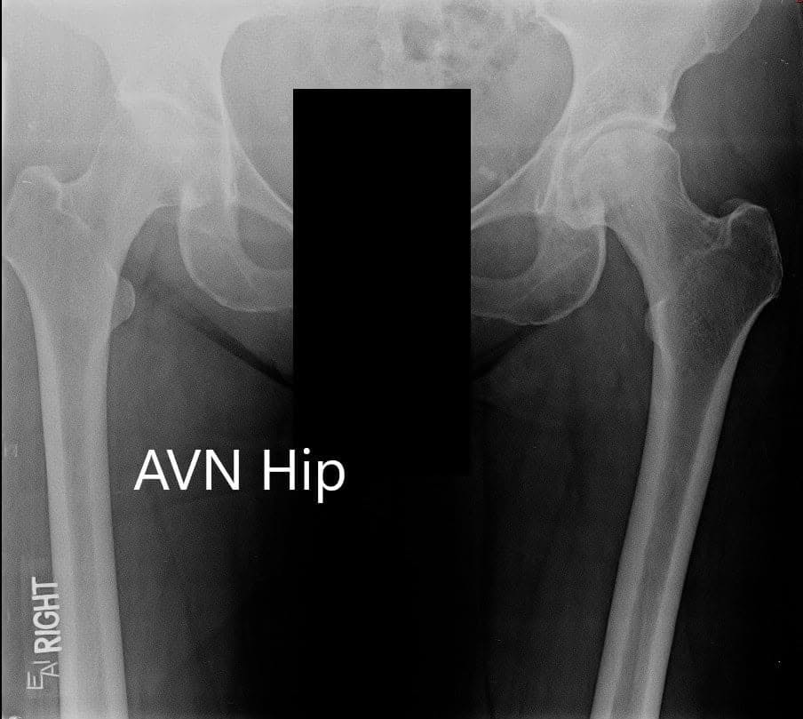Radiografía que muestra la vista AP de la pelvis con ambas articulaciones de la cadera Radiografía que muestra la vista AP de la pelvis con ambas articulaciones de la cadera
