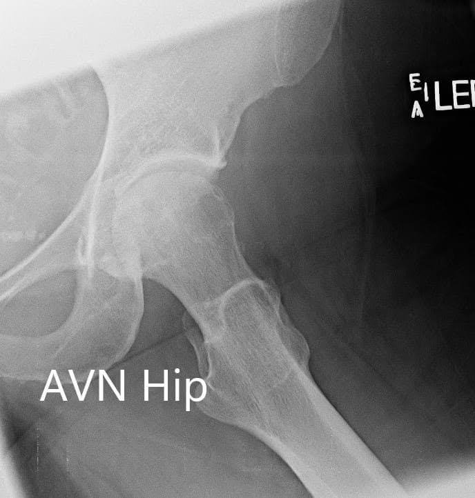 Radiografía que muestra las vistas AP y laterales con patas de rana de la articulación de la cadera izquierda - IMG 2 Radiografía que muestra las vistas AP y laterales con patas de rana de la articulación de la cadera izquierda - IMG 2