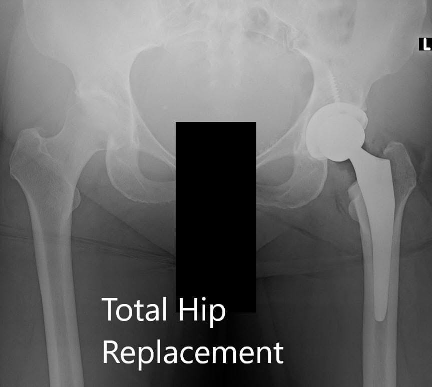 Radiografía postoperatoria de la pelvis que muestra visión AP y lateral Radiografía postoperatoria de la pelvis que muestra visión AP y lateral