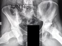 Preoperative X-ray of the pelvis with both hips in frog-legged lateral views Preoperative X-ray of the pelvis with both hips in frog-legged lateral views
