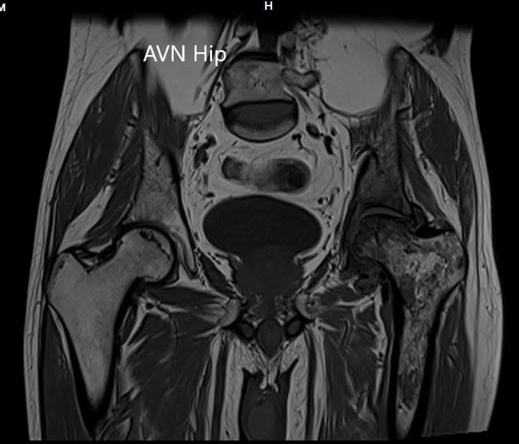MRI showing the T1WI of the pelvis MRI showing the T1WI of the pelvis