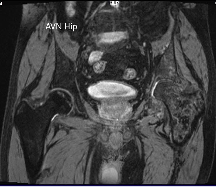 MRI showing the T2WI of the pelvis MRI showing the T2WI of the pelvis