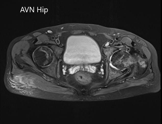 Axial section of the T2WI of the pelvis Axial section of the T2WI of the pelvis