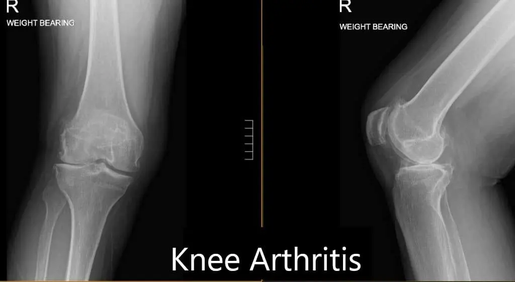 Artroplastia total de rodilla derecha