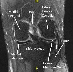 Resonancia magnética de rodilla en secciones coronal y sagital