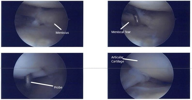 Imágenes artroscópicas intraoperatorias