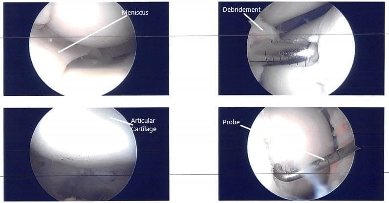 Imágenes artroscópicas intraoperatorias 2