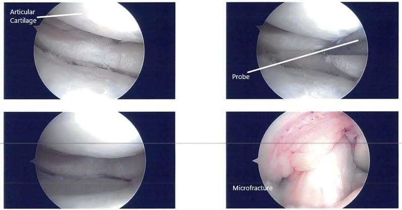Imágenes artroscópicas intraoperatorias 3