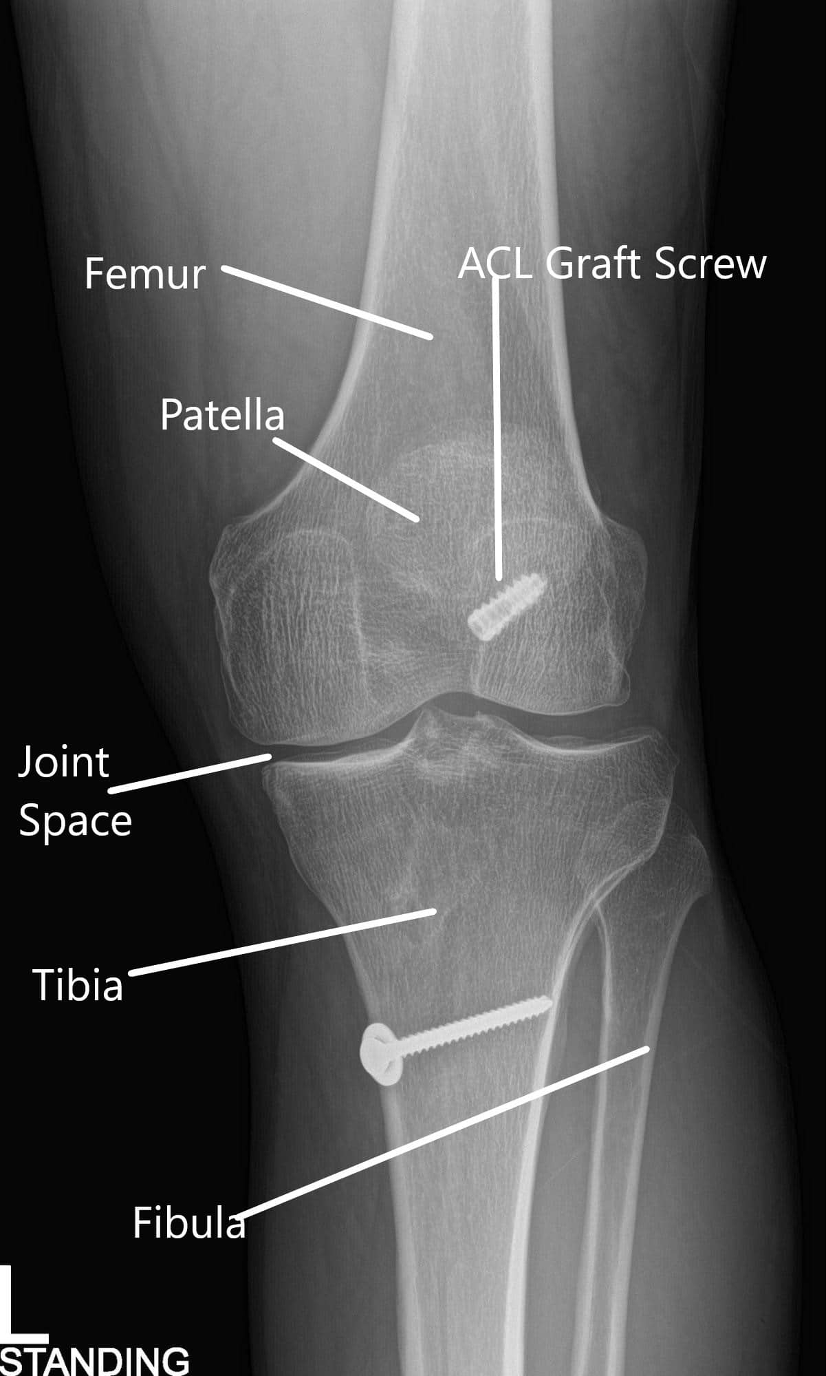X-ray of the left knee in AP and Lateral views X-ray of the left knee in AP and Lateral views