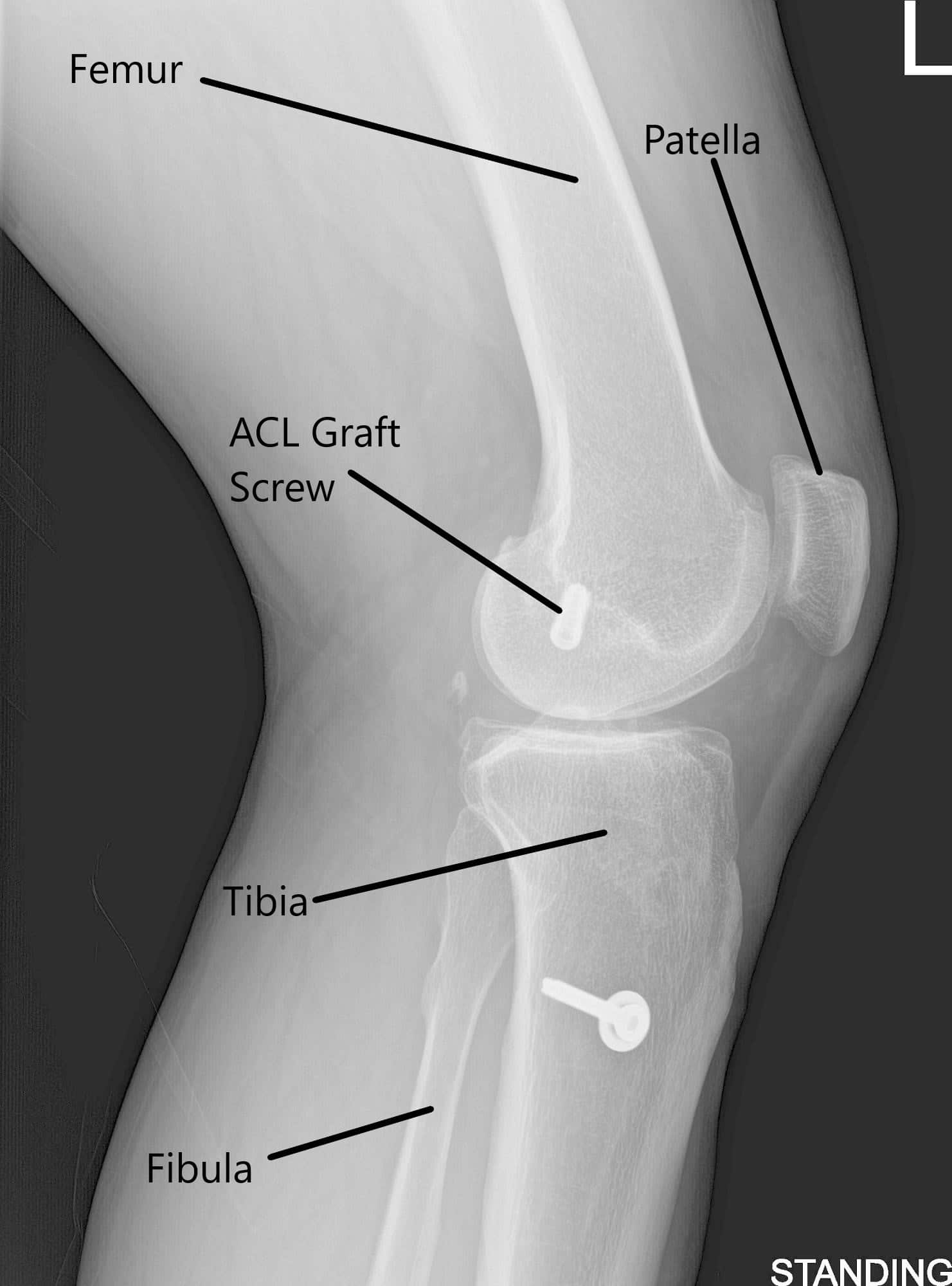 X-ray of the left knee in AP and Lateral views X-ray of the left knee in AP and Lateral views