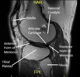 Sagittal MRI view of the left knee Sagittal MRI view of the left knee