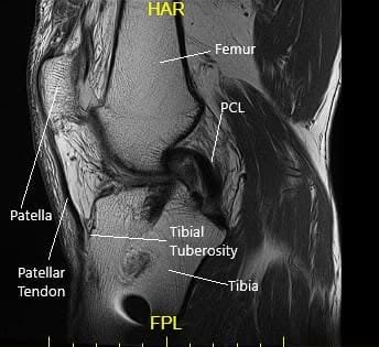 Sagittal MRI view of the left knee 2 Sagittal MRI view of the left knee 2