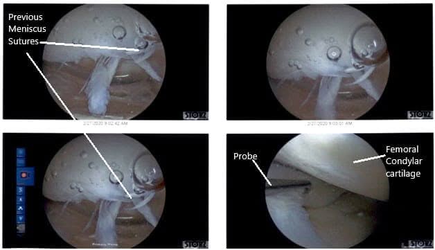 Intraoperative Arthroscopic Views of the left knee Intraoperative Arthroscopic Views of the left knee