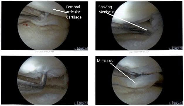 Intraoperative Arthroscopic Views of the left knee 2 Intraoperative Arthroscopic Views of the left knee 2