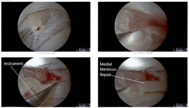 Intraoperative Arthroscopic Views of the left knee 3 Intraoperative Arthroscopic Views of the left knee 3
