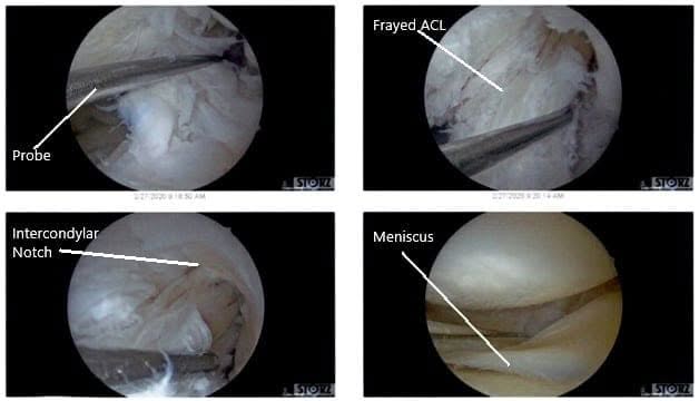 Intraoperative Arthroscopic Views of the left knee 4 Intraoperative Arthroscopic Views of the left knee 4