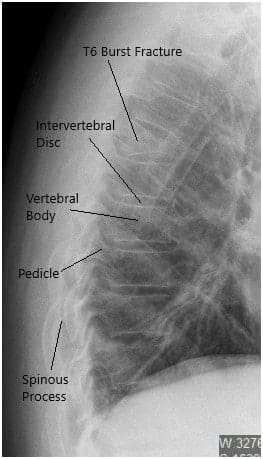 Radiografía preoperatoria de la columna toracolumbar en vista lateral