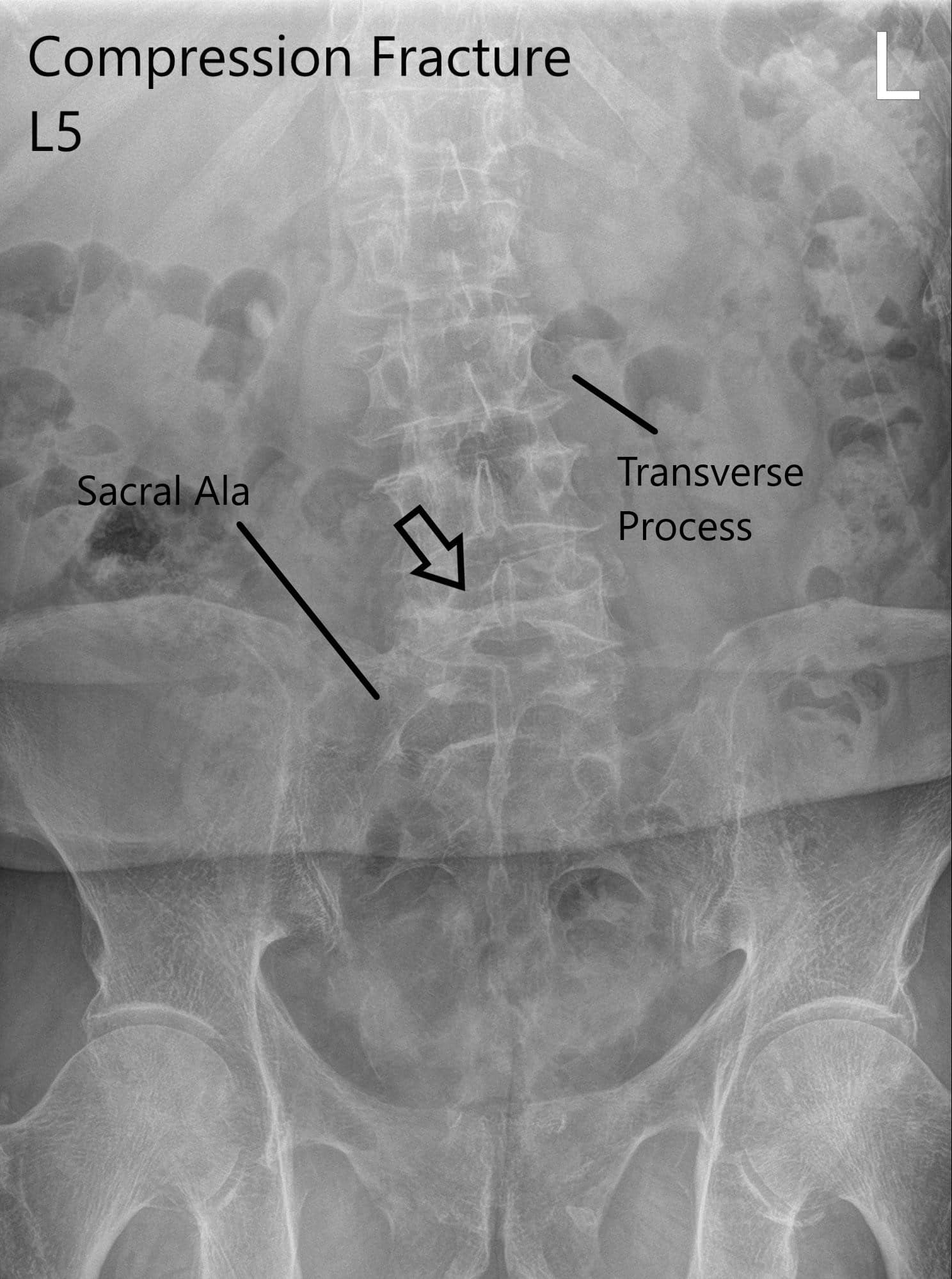 Radiografía de la columna LS en vistas AP y laterales que muestran fractura por compresión significativa en L5 Radiografía de la columna LS en vistas AP y laterales que muestran fractura por compresión significativa en L5