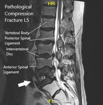 Resonancia magnética que muestra sección sagital de la columna lumbar sacra Resonancia magnética que muestra sección sagital de la columna lumbar sacra