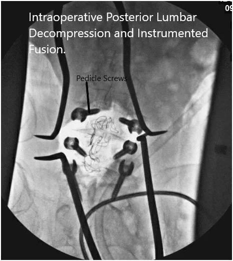 Imágenes de fluoroscopia intraoperatoria Imágenes de fluoroscopia intraoperatoria