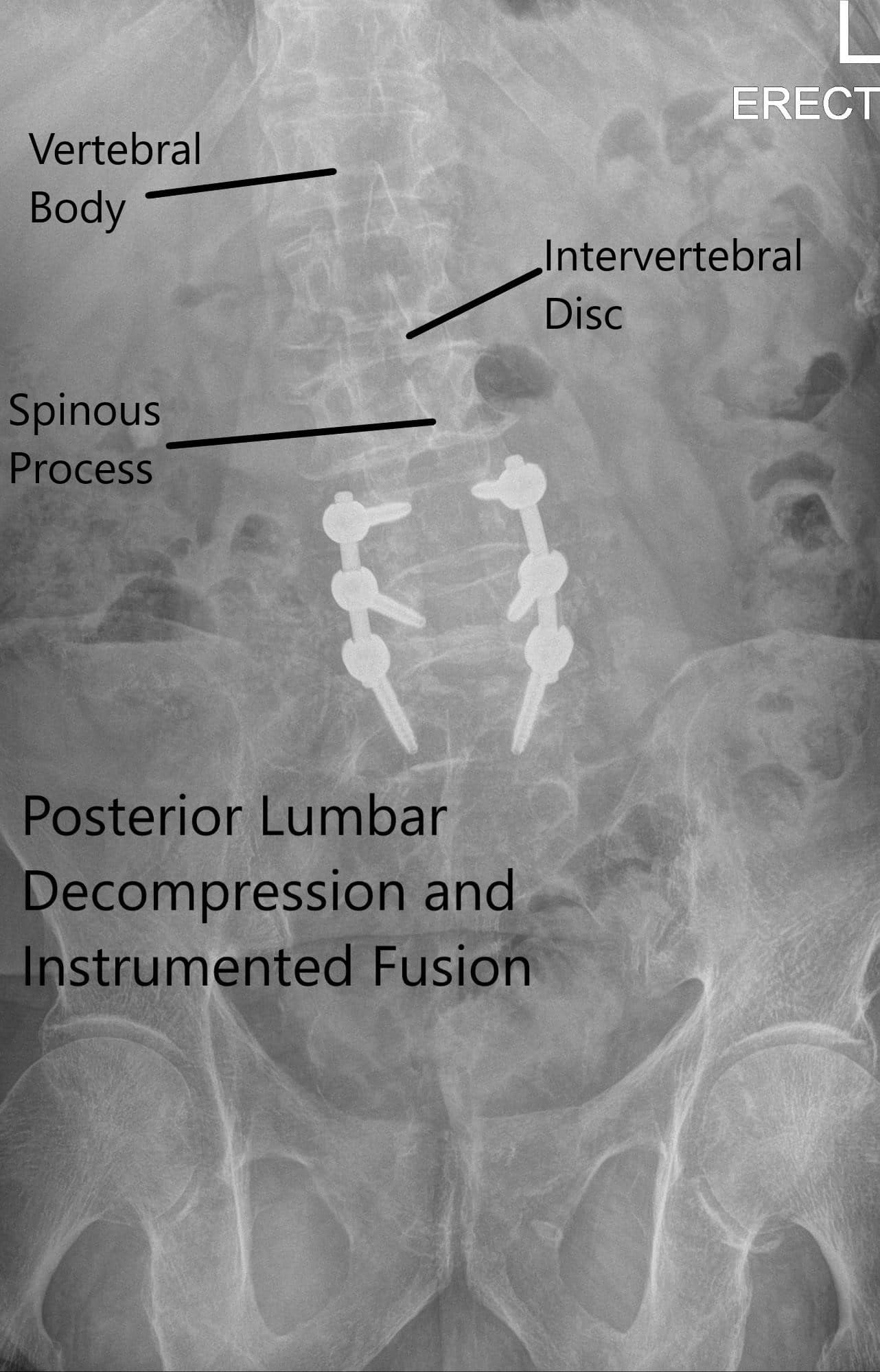Radiografía postoperatoria que muestra la visión AP y lateral Radiografía postoperatoria que muestra la visión AP y lateral