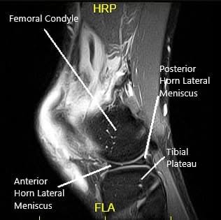 MRI of the left knee in the sagittal and coronal view MRI of the left knee in the sagittal and coronal view