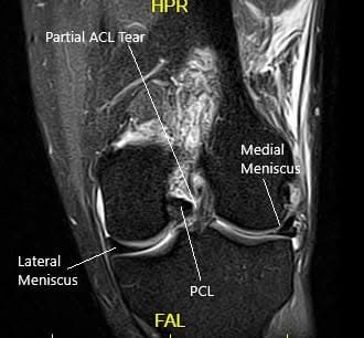 MRI of the left knee in the sagittal and coronal view 2 MRI of the left knee in the sagittal and coronal view 2