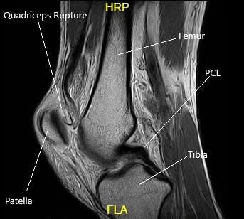 MRI of the Left Knee in the sagittal section MRI of the Left Knee in the sagittal section