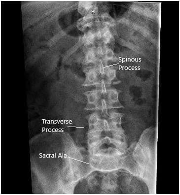 X-ray in AP and Lateral views demonstrated narrowing of the L5-S1 Disc X-ray in AP and Lateral views demonstrated narrowing of the L5-S1 Disc