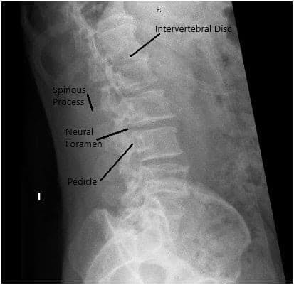 X-ray in AP and Lateral views demonstrated narrowing of the L5-S1 Disc 2 X-ray in AP and Lateral views demonstrated narrowing of the L5-S1 Disc 2