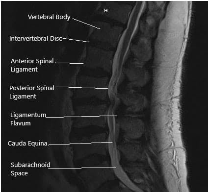 MRI of the Lumbosacral spine in sagittal and axial sections MRI of the Lumbosacral spine in sagittal and axial sections