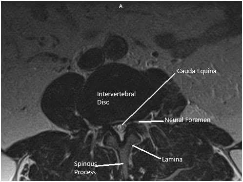 MRI of the Lumbosacral spine in sagittal and axial sections 2 MRI of the Lumbosacral spine in sagittal and axial sections 2