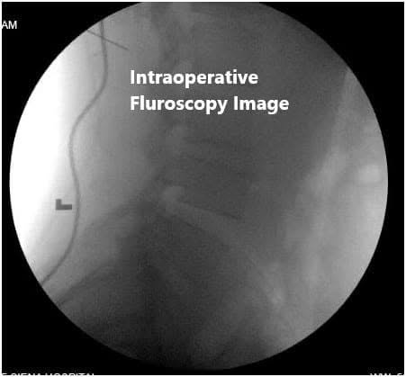 Intraoperative fluoroscopic images Intraoperative fluoroscopic images