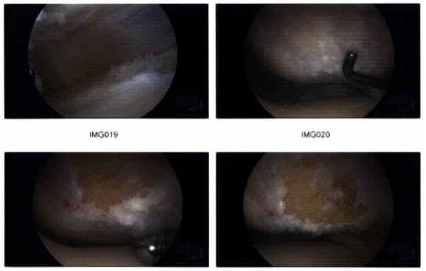 Intraoperative arthroscopic images 2 Intraoperative arthroscopic images 2