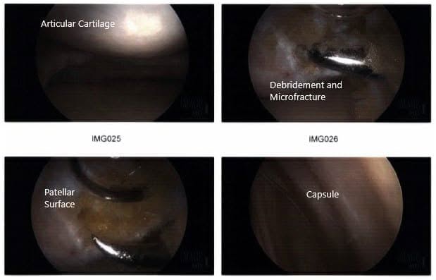 Intraoperative arthroscopic images 3 Intraoperative arthroscopic images 3