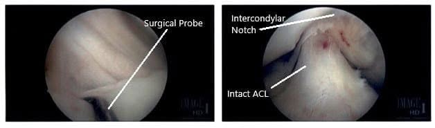 Imágenes artroscópicas intraoperatorias de la rodilla derecha Imágenes artroscópicas intraoperatorias de la rodilla derecha