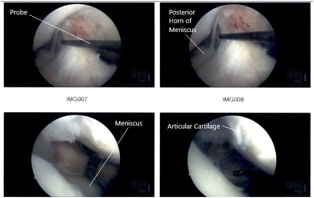 Intraoperative Arthroscopic Images of the right knee