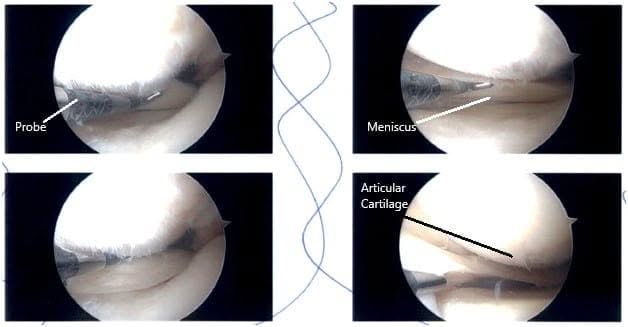 Imágenes de artroscopia intraoperatoria Imágenes de artroscopia intraoperatoria