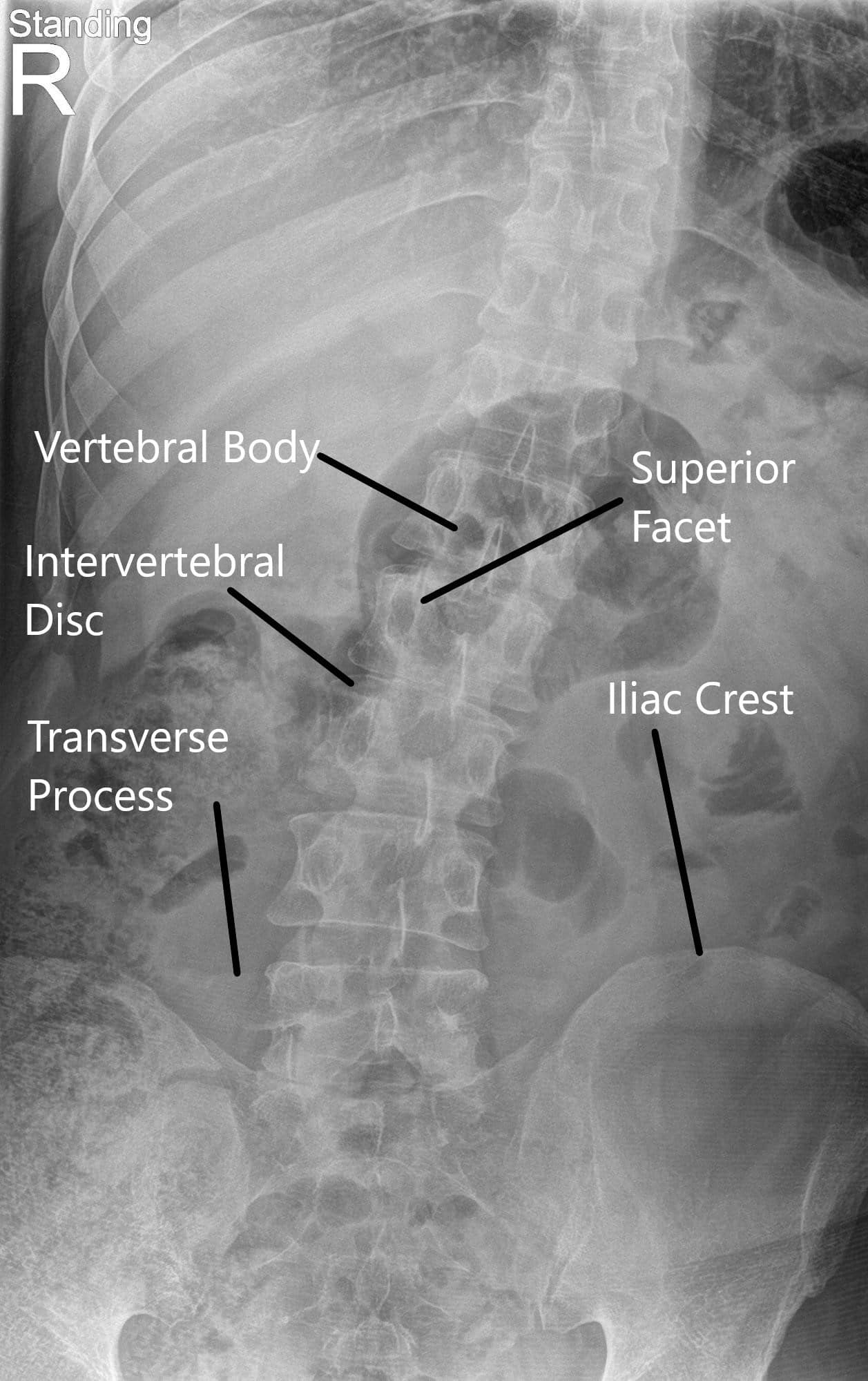 LS Spine X-ray in AP and Lateral views LS Spine X-ray in AP and Lateral views