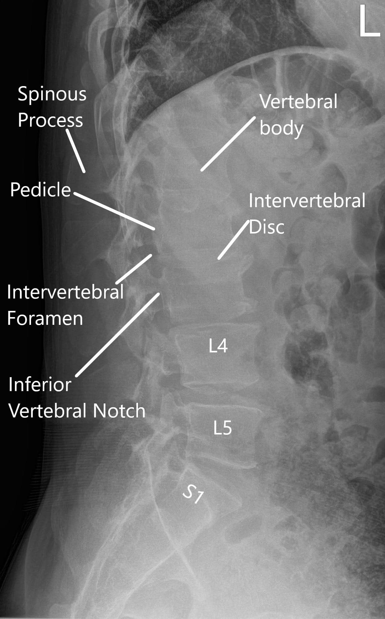LS Spine X-ray in AP and Lateral views 2 LS Spine X-ray in AP and Lateral views 2